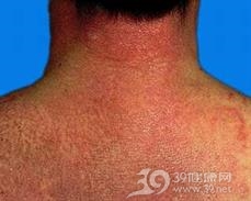 皮肌炎