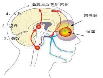 偏头痛