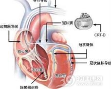 起搏器综合征