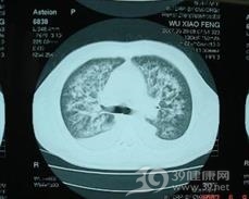 气单胞菌肺炎