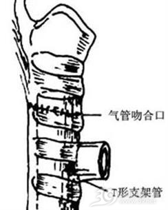 气管闭合性损伤