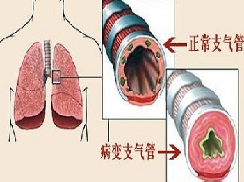 气管炎