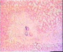 轻链病与轻链沉积病