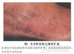 全身性特发性毛细血管扩张症