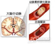 腔隙性脑梗塞