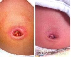 脐炎