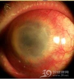 强直性脊柱炎性巩膜炎
