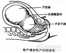 软产道异常性难产