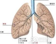 妊娠合并肺栓塞
