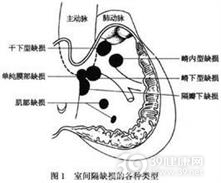 妊娠合并心房间隔缺损