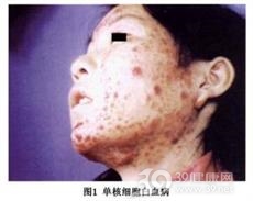 髓单核细胞白血病