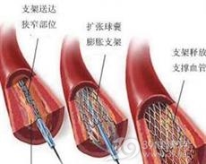 肾动脉狭窄