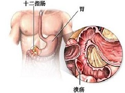 十二指肠溃疡