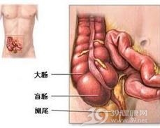 十二指肠旁疝