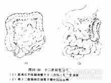 十二指肠血管性压迫综合征