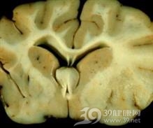 散发性脑炎伴发的精神障碍