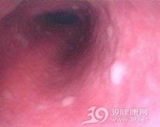 食管白斑