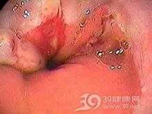 食管贲门粘膜撕裂综合征