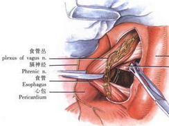 食管壁内憩室