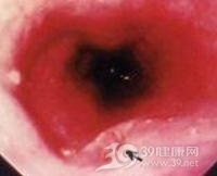 食管结核