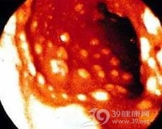 食管克罗恩病