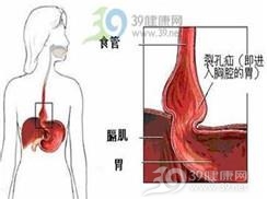 食管裂孔疝