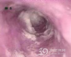 食管黏膜损伤
