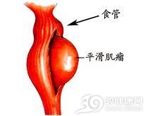 食管平滑肌瘤