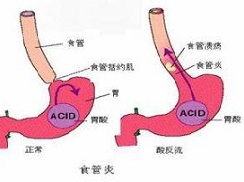 食管炎