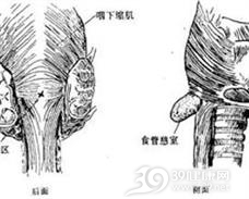 食管中段憩室