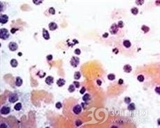 砷化氢引起的溶血性贫血