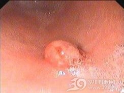 神经官能性表皮剥脱
