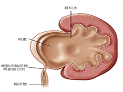 肾积水