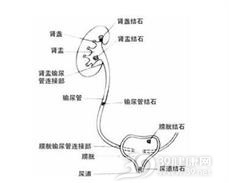肾及输尿管结石