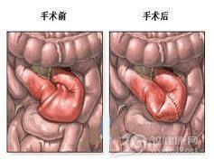 神经性肠梗阻综合症