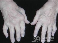 松毛虫病骨关节病