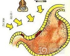 手术后反流性胃炎