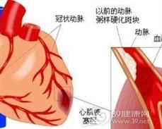 肾上腺素能依赖性尖端扭转性室性心动过速