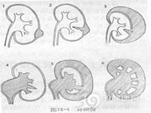肾上腺髓质功能亢进