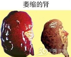肾萎缩
