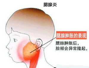腮腺炎