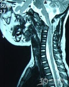 枢椎齿突骨折