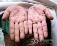 砷中毒