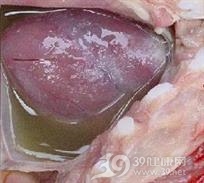 缩窄性心包炎