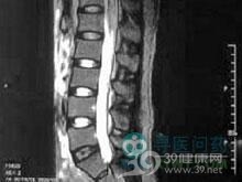 糖尿病所致脊髓病