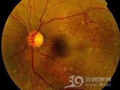 糖尿病性视网膜病变