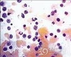 铜中毒引起的溶血性贫血