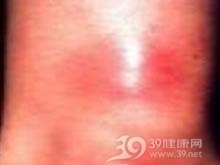 微病毒B19感染性风湿病