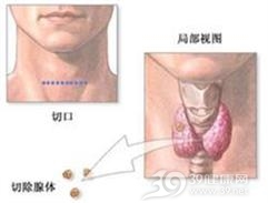 无功能性甲状旁腺囊肿