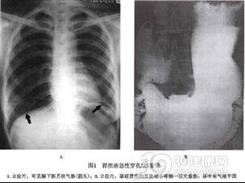 胃溃疡性穿孔